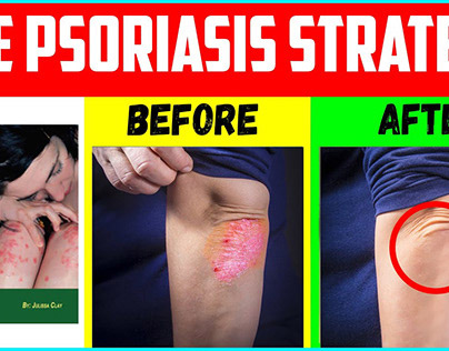 The Psoriasis Strategy